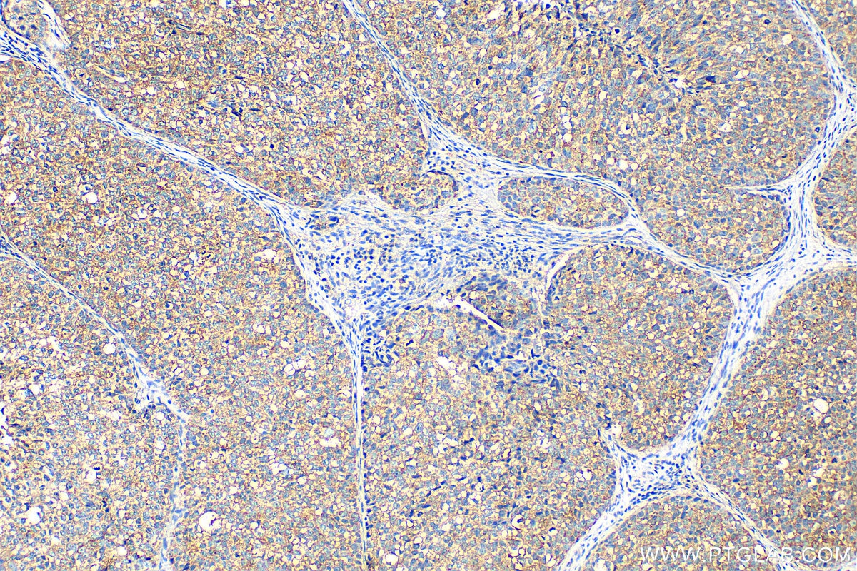 Immunohistochemistry (IHC) staining of human breast cancer tissue using Fibroblast activation protein alpha Polyclonal ant (27596-1-AP)