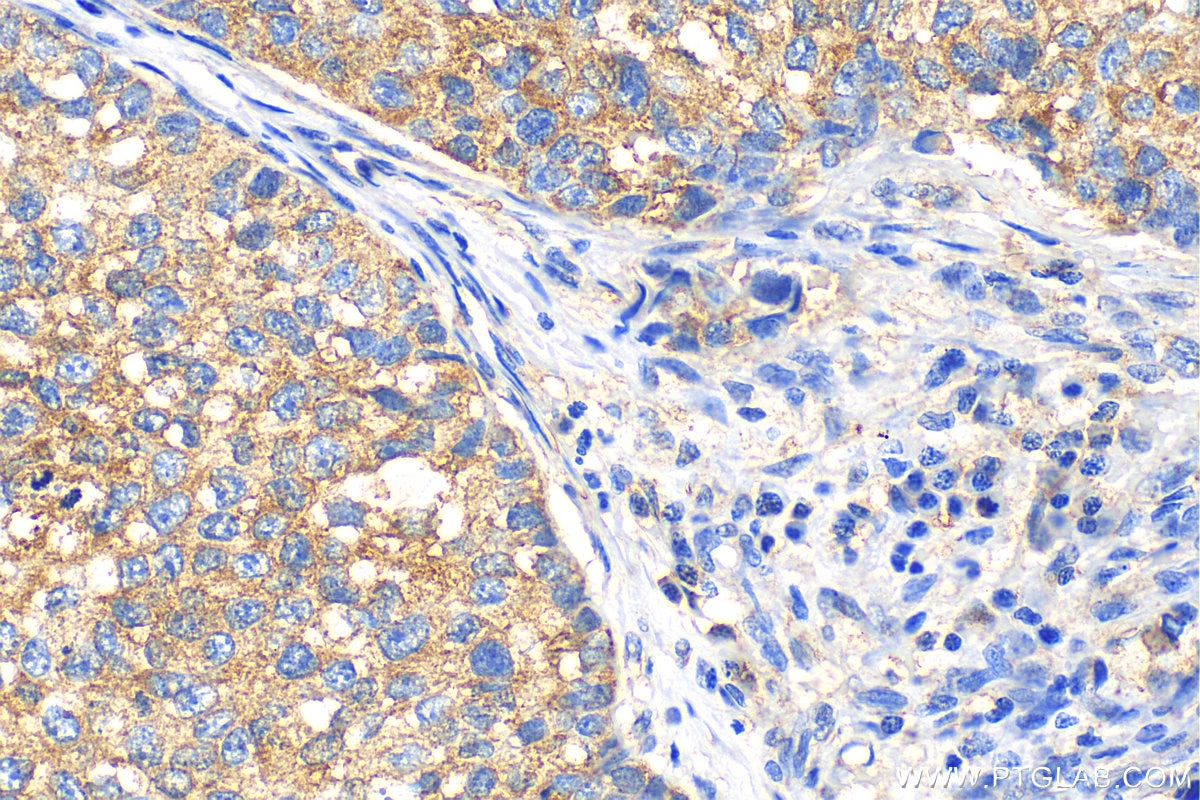 Immunohistochemistry (IHC) staining of human breast cancer tissue using Fibroblast activation protein alpha Polyclonal ant (27596-1-AP)