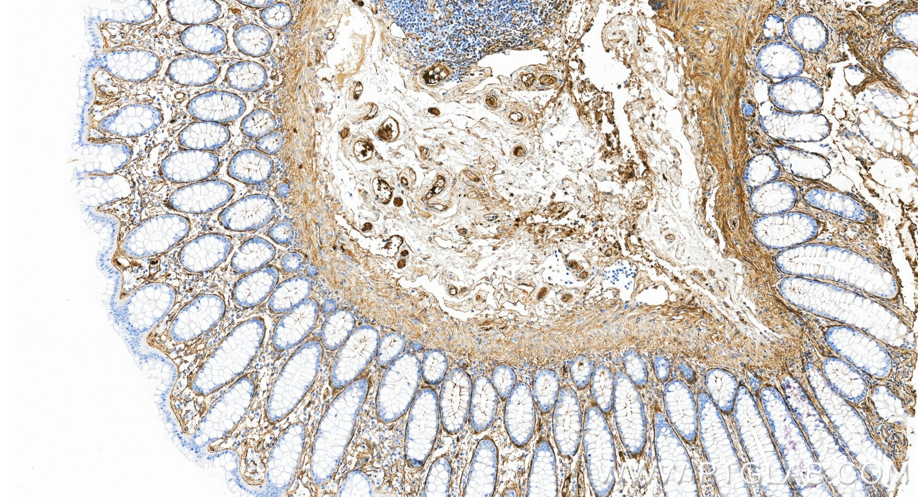 IHC staining of human colon using 98652-2-RR (same clone as 98652-2-PBS) Immunohistochemistry (IHC) staining of human colon tissue using Anti-Human Fibronectin Rabbit Recombinant Antibody (98652-2-RR)
