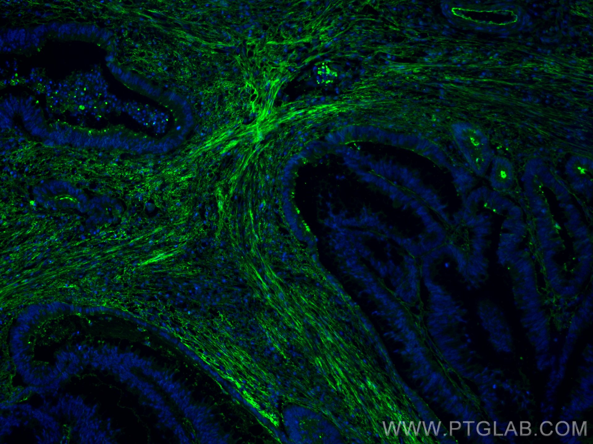 IF Staining of human colon cancer using CL488-66042