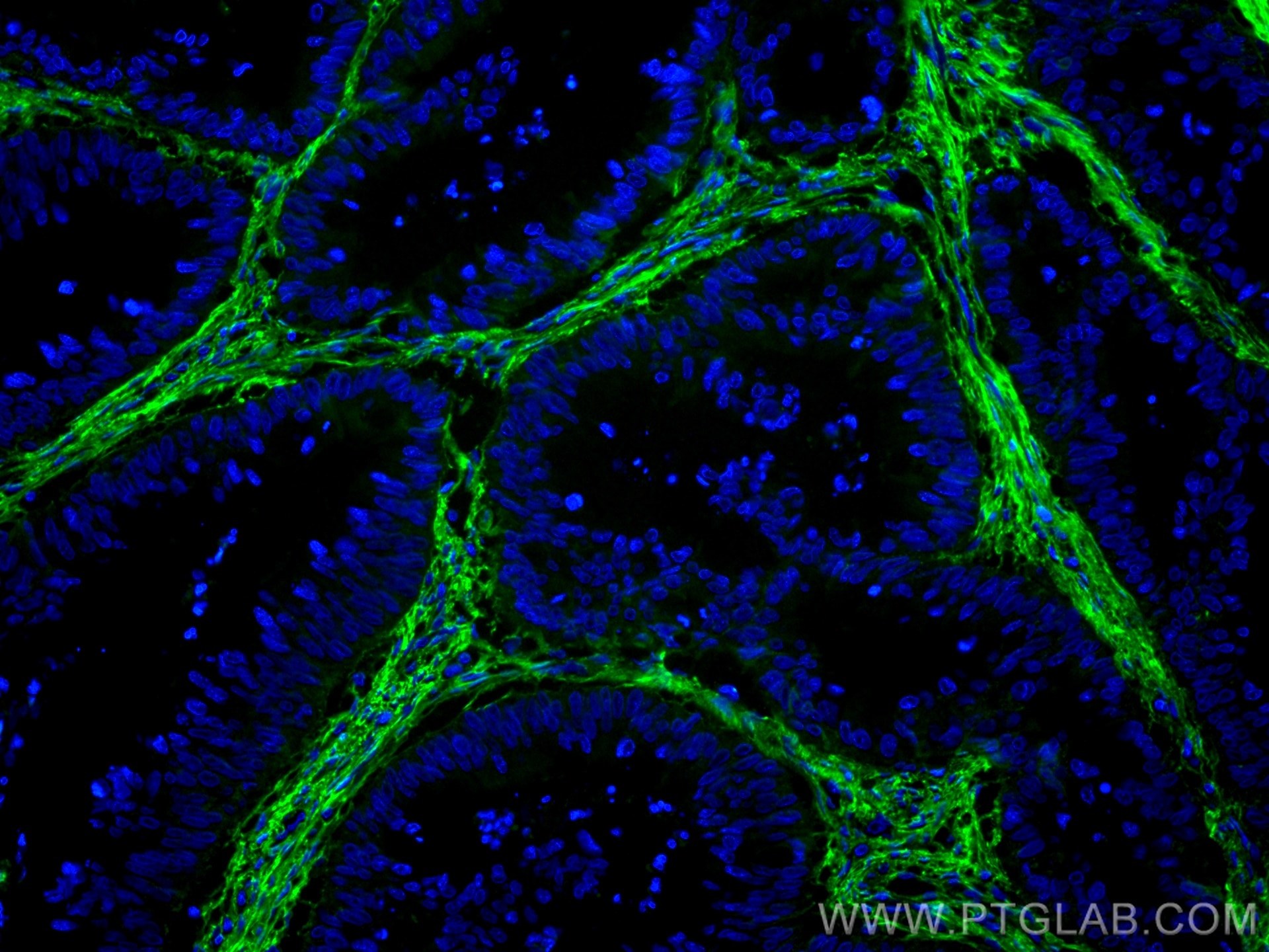 Immunofluorescence (IF) / fluorescent staining of human colon cancer tissue using CoraLite® Plus 488-conjugated Fibronectin Monoclon (CL488-66042)