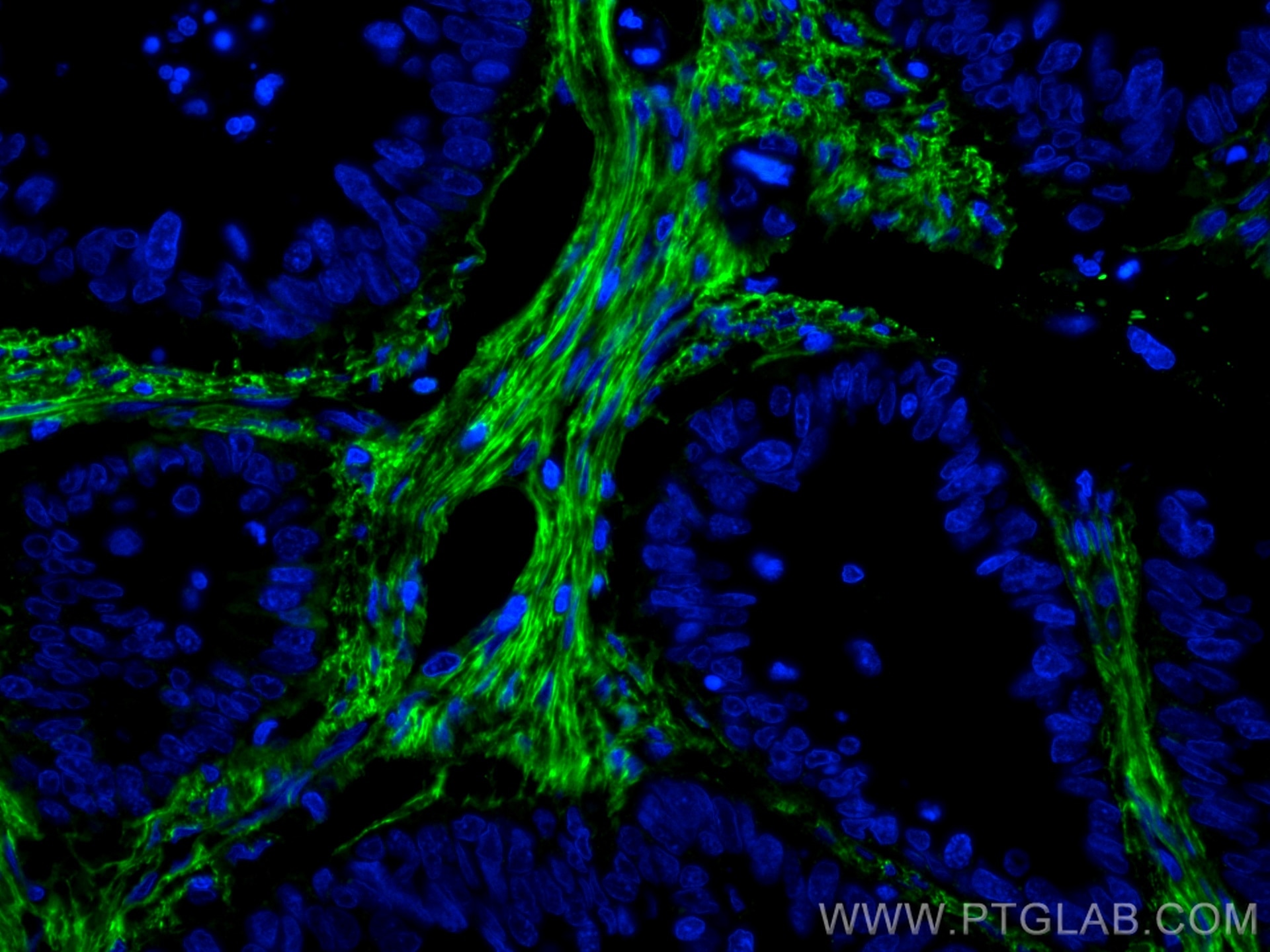 Immunofluorescence (IF) / fluorescent staining of human colon cancer tissue using CoraLite® Plus 488-conjugated Fibronectin Monoclon (CL488-66042)