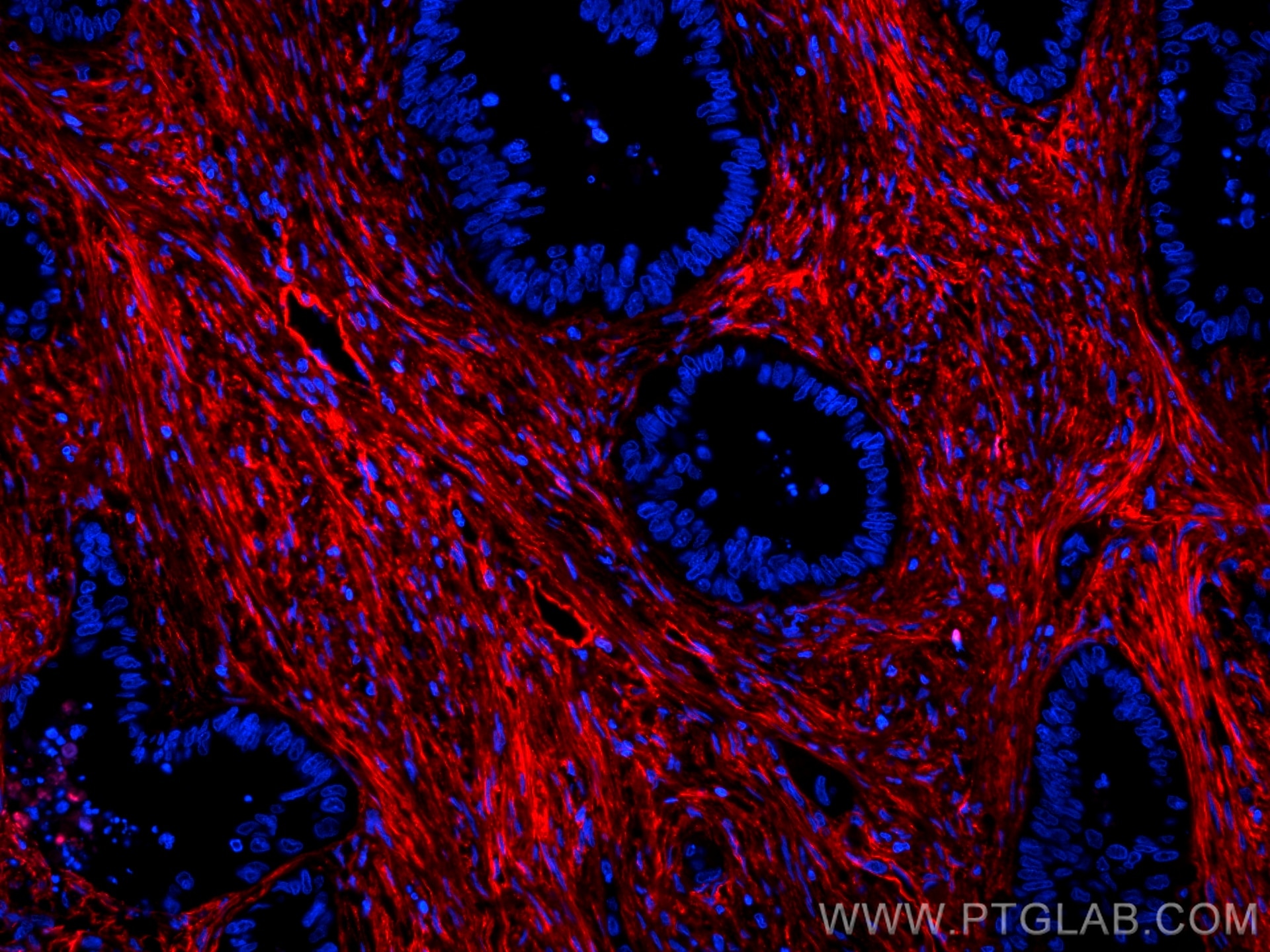 Immunofluorescence (IF) / fluorescent staining of human colon cancer tissue using CoraLite®594-conjugated Fibronectin Monoclonal ant (CL594-66042)
