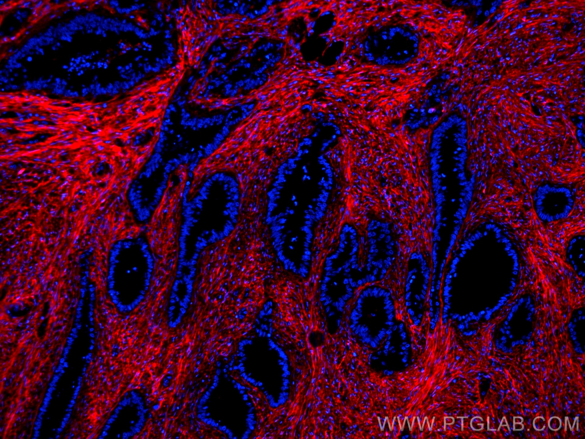 Immunofluorescence (IF) / fluorescent staining of human colon cancer tissue using CoraLite®594-conjugated Fibronectin Monoclonal ant (CL594-66042)