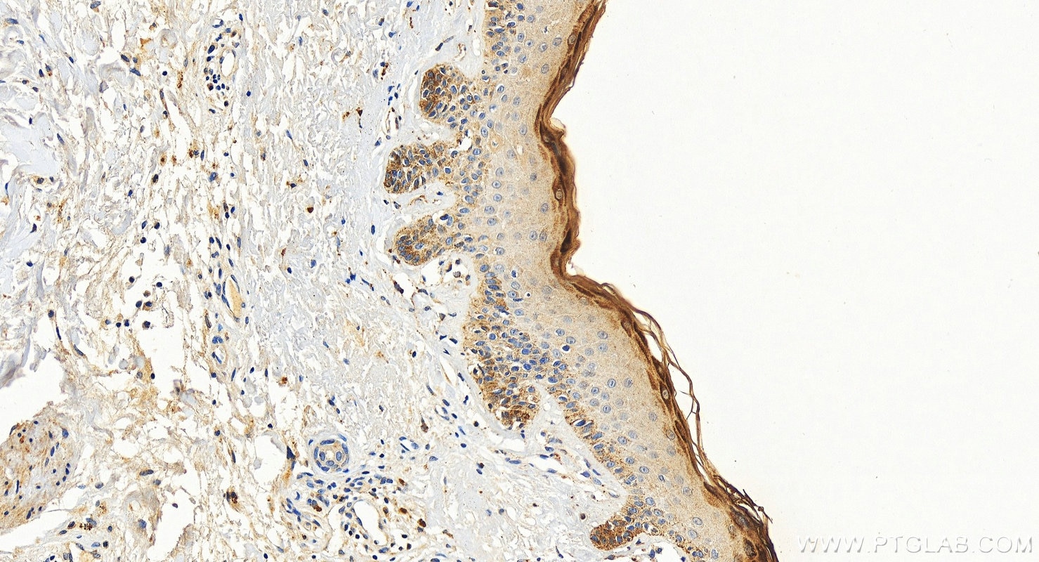 IHC staining of human paracancerous of skin squamous cell cancer using 26931-1-AP (same clone as 26931-1-PBS) Immunohistochemistry (IHC) staining of human paracancerous of skin squamous cell cancer t using Filaggrin Polyclonal antibody (26931-1-AP)