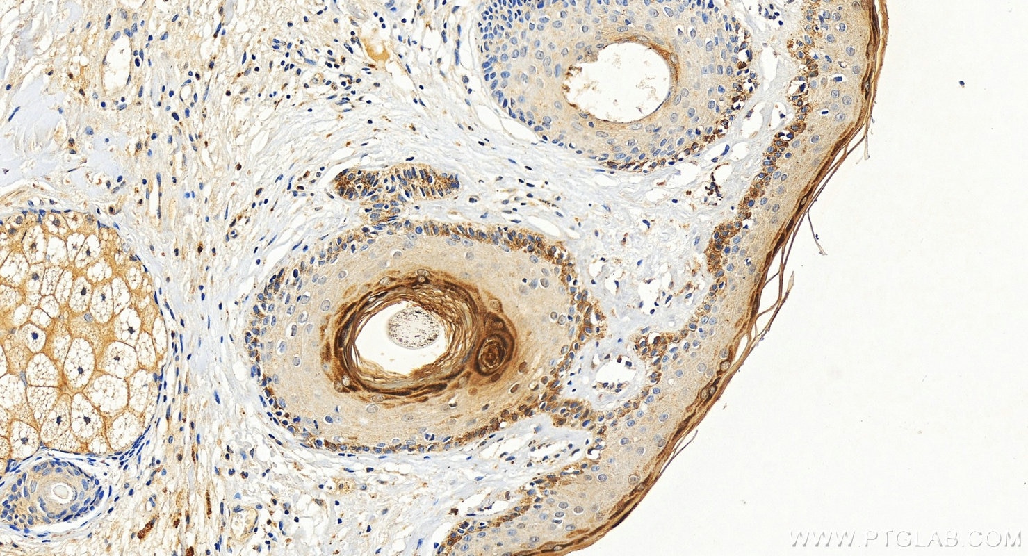 IHC staining of human paracancerous of skin squamous cell cancer using 26931-1-AP (same clone as 26931-1-PBS) Immunohistochemistry (IHC) staining of human paracancerous of skin squamous cell cancer t using Filaggrin Polyclonal antibody (26931-1-AP)