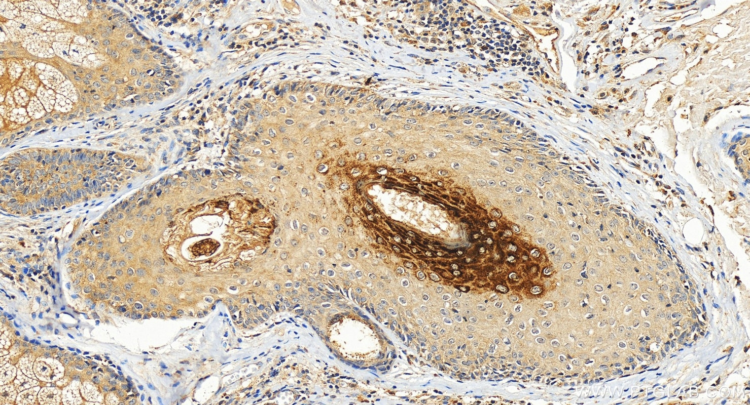IHC staining of human skin squamous cell cancer using 26931-1-AP (same clone as 26931-1-PBS) Immunohistochemistry (IHC) staining of human skin squamous cell cancer tissue using Filaggrin Polyclonal antibody (26931-1-AP)