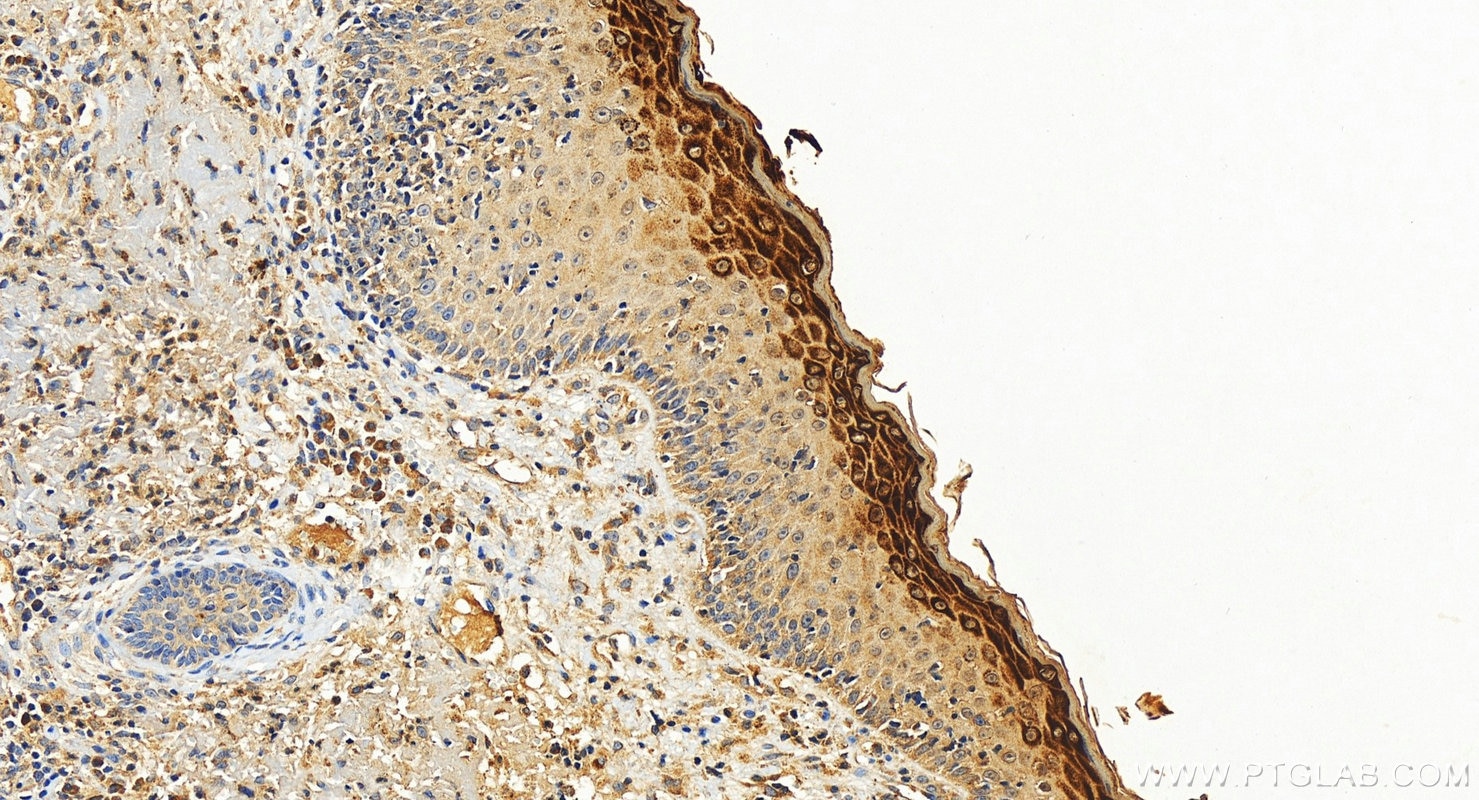 IHC staining of human skin squamous cell cancer using 26931-1-AP (same clone as 26931-1-PBS) Immunohistochemistry (IHC) staining of human skin squamous cell cancer tissue using Filaggrin Polyclonal antibody (26931-1-AP)