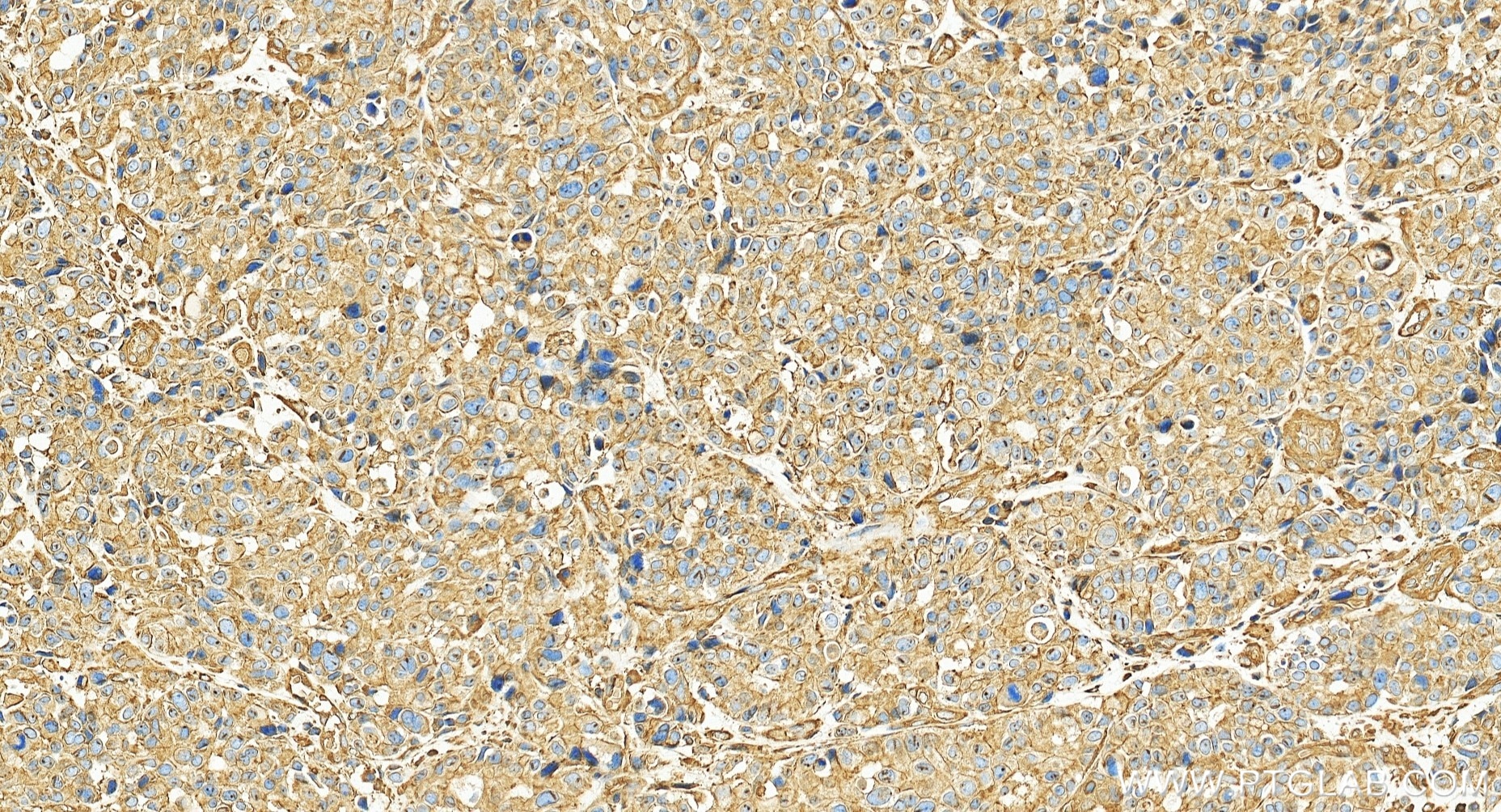 Immunohistochemistry (IHC) staining of human stomach cancer tissue using Filamin A Recombinant monoclonal antibody (86959-3-RR)