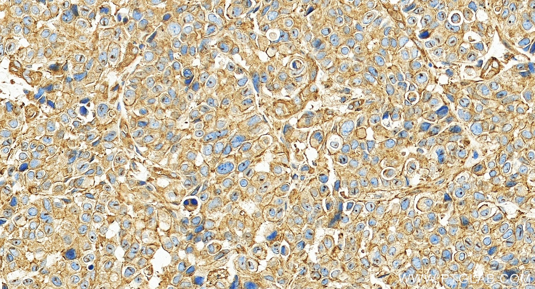 Immunohistochemistry (IHC) staining of human stomach cancer tissue using Filamin A Recombinant monoclonal antibody (86959-3-RR)
