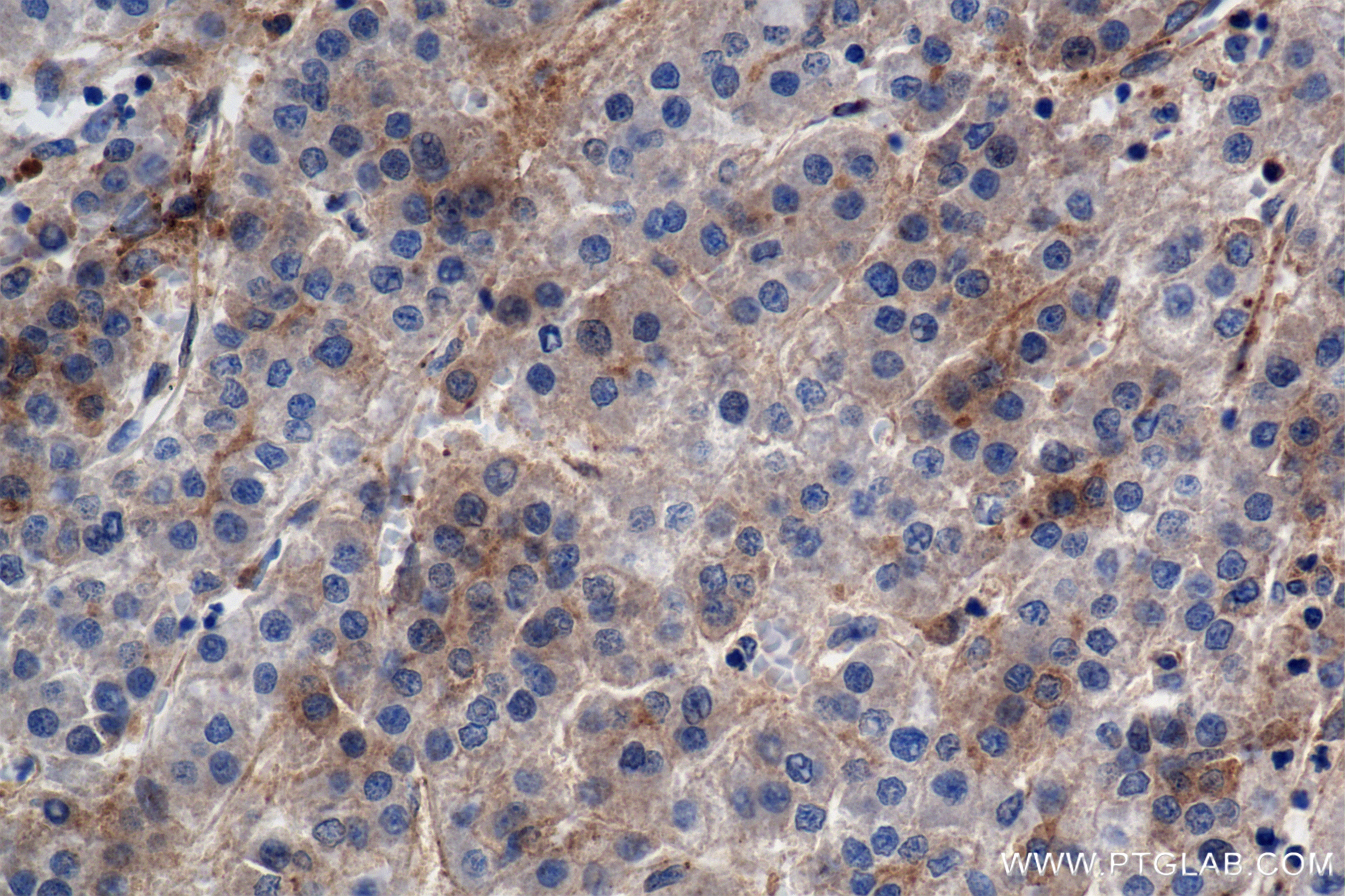 Immunohistochemistry (IHC) staining of human hepatocellular cancer using Filamin B Recombinant antibody (85202-1-RR)