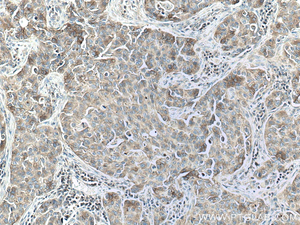 Immunohistochemistry (IHC) staining of human breast cancer tissue using Flotillin 2 Polyclonal antibody (28208-1-AP)