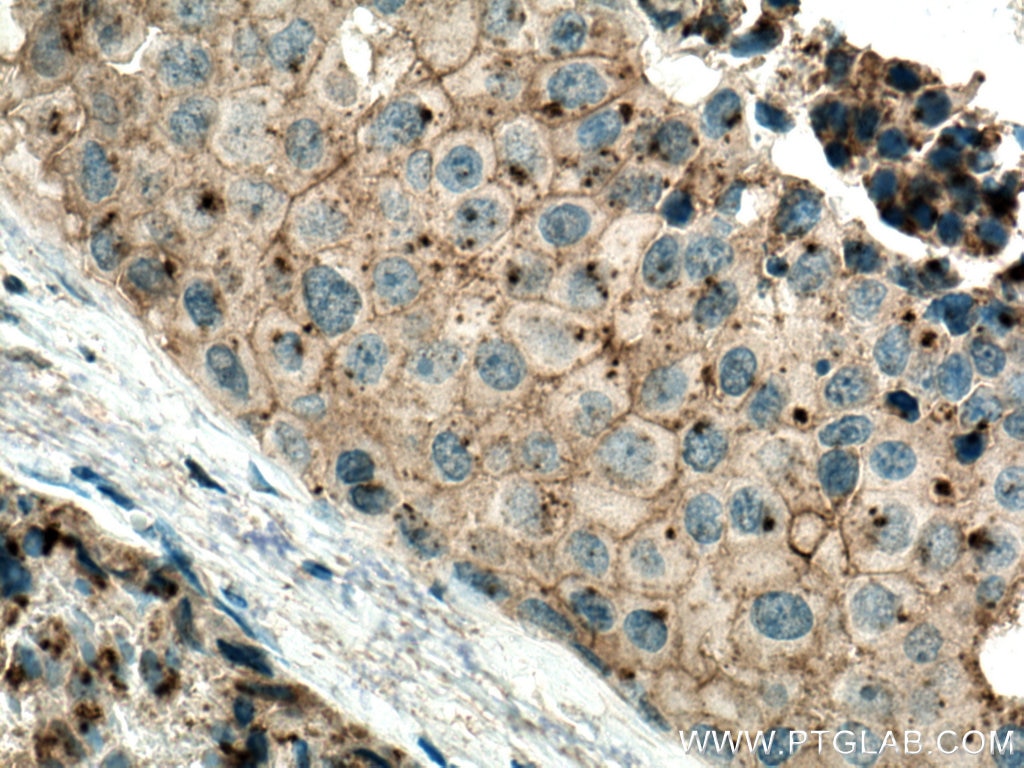 Immunohistochemistry (IHC) staining of human breast cancer tissue using Flotillin 2 Monoclonal antibody (66881-1-Ig)