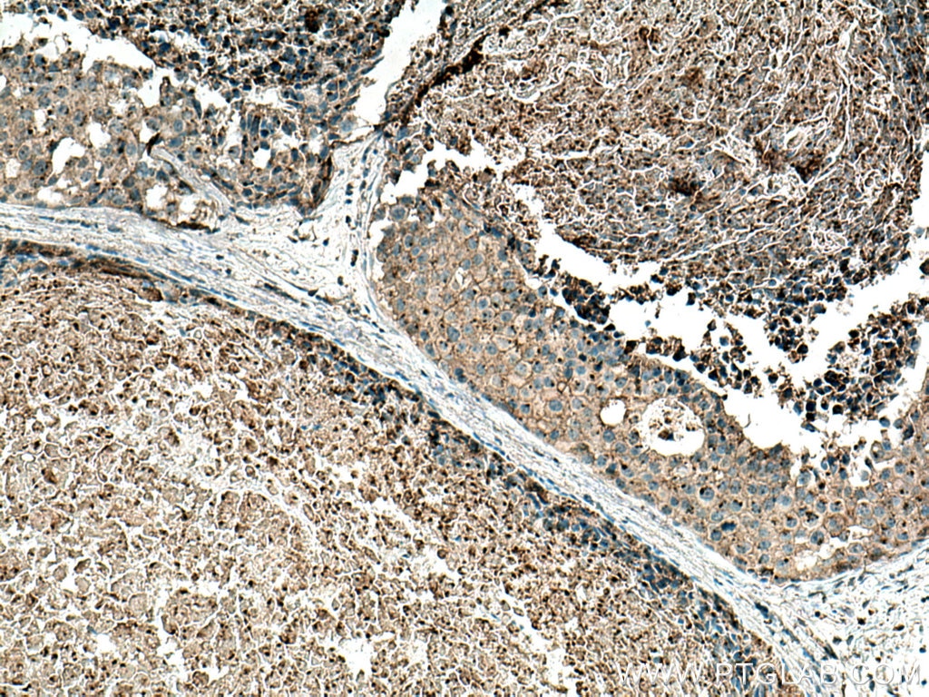 Immunohistochemistry (IHC) staining of human breast cancer tissue using Flotillin 2 Monoclonal antibody (66881-1-Ig)