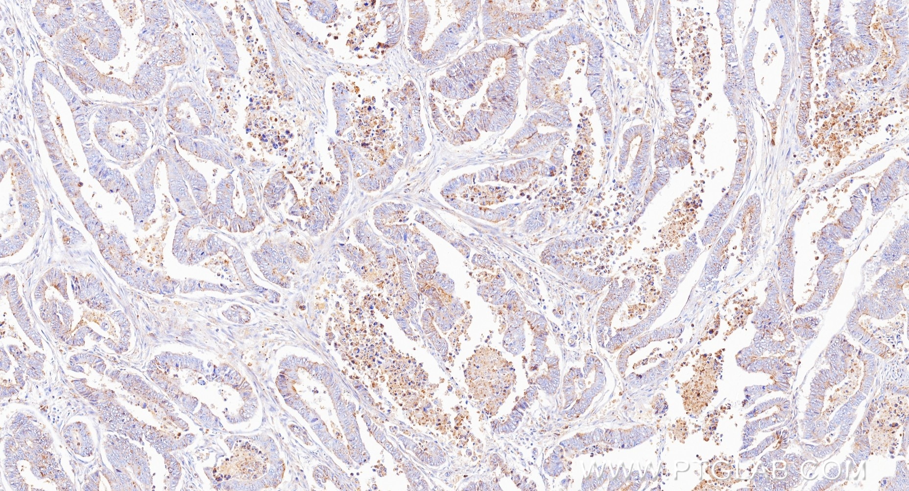 Immunohistochemistry (IHC) staining of human colon cancer tissue using Flotillin 2 Recombinant monoclonal antibody (88149-1-RR)