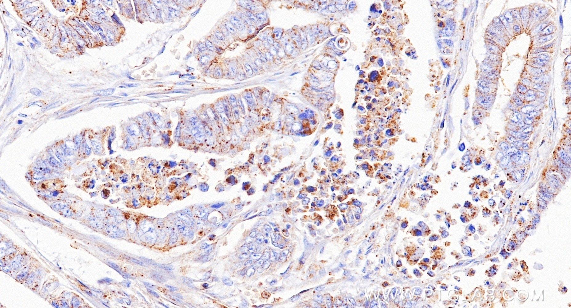 Immunohistochemistry (IHC) staining of human colon cancer tissue using Flotillin 2 Recombinant monoclonal antibody (88149-1-RR)