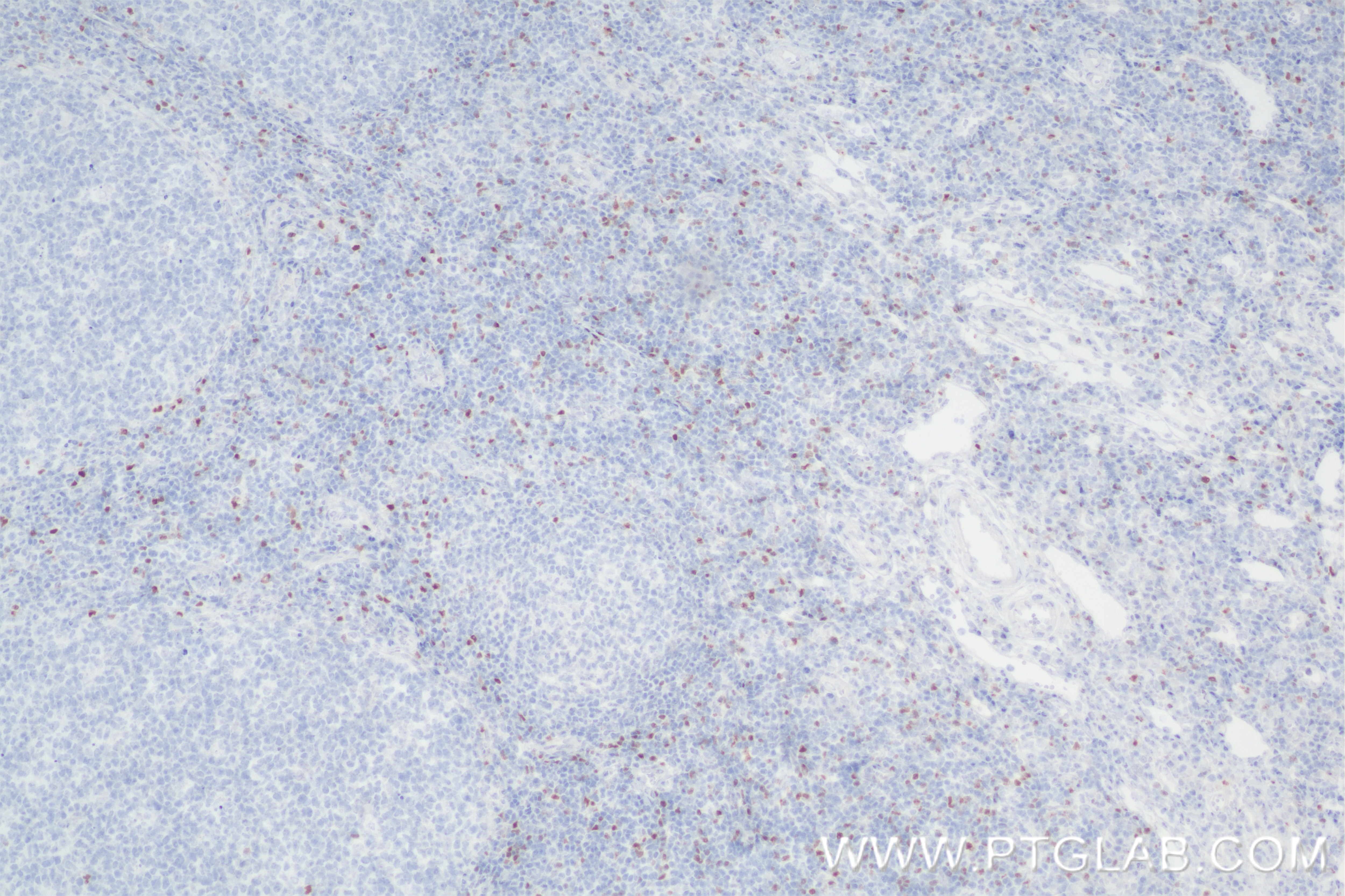 Immunohistochemistry (IHC) staining of human tonsillitis tissue using Foxp3 Recombinant antibody (85128-6-RR)
