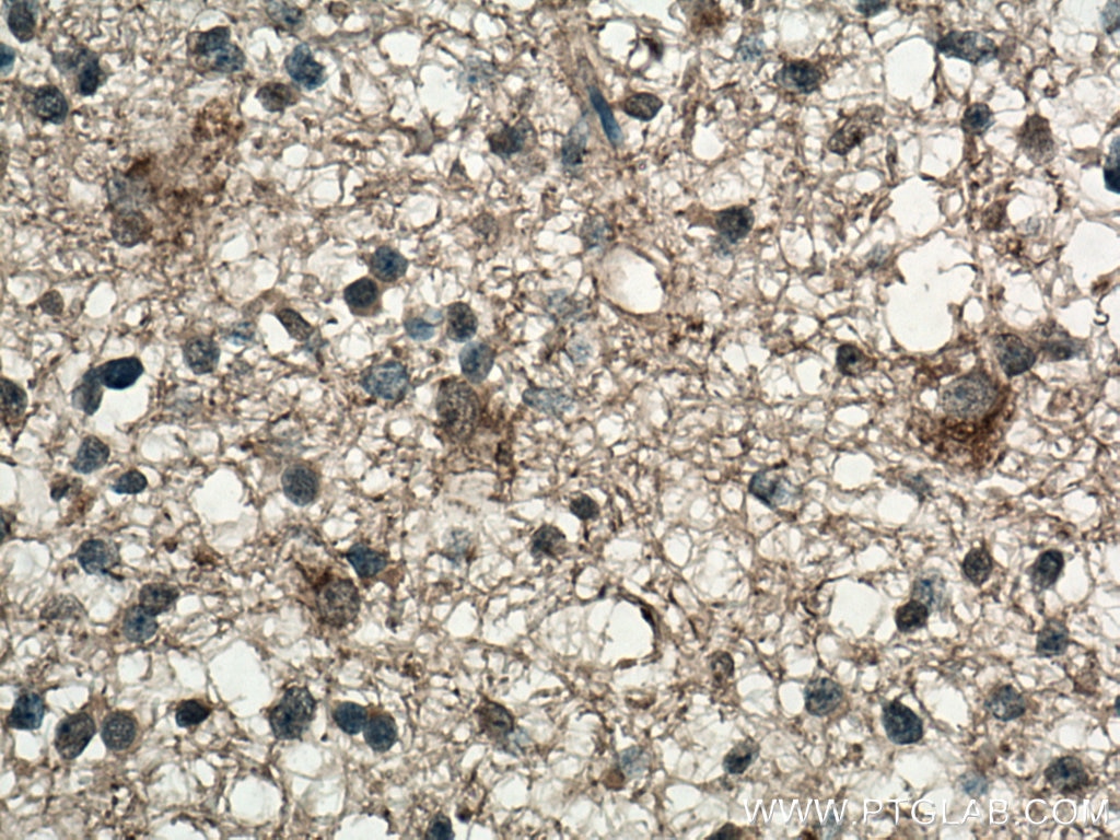 Immunohistochemistry (IHC) staining of human gliomas tissue using Frizzled 9 Monoclonal antibody (67023-1-Ig)
