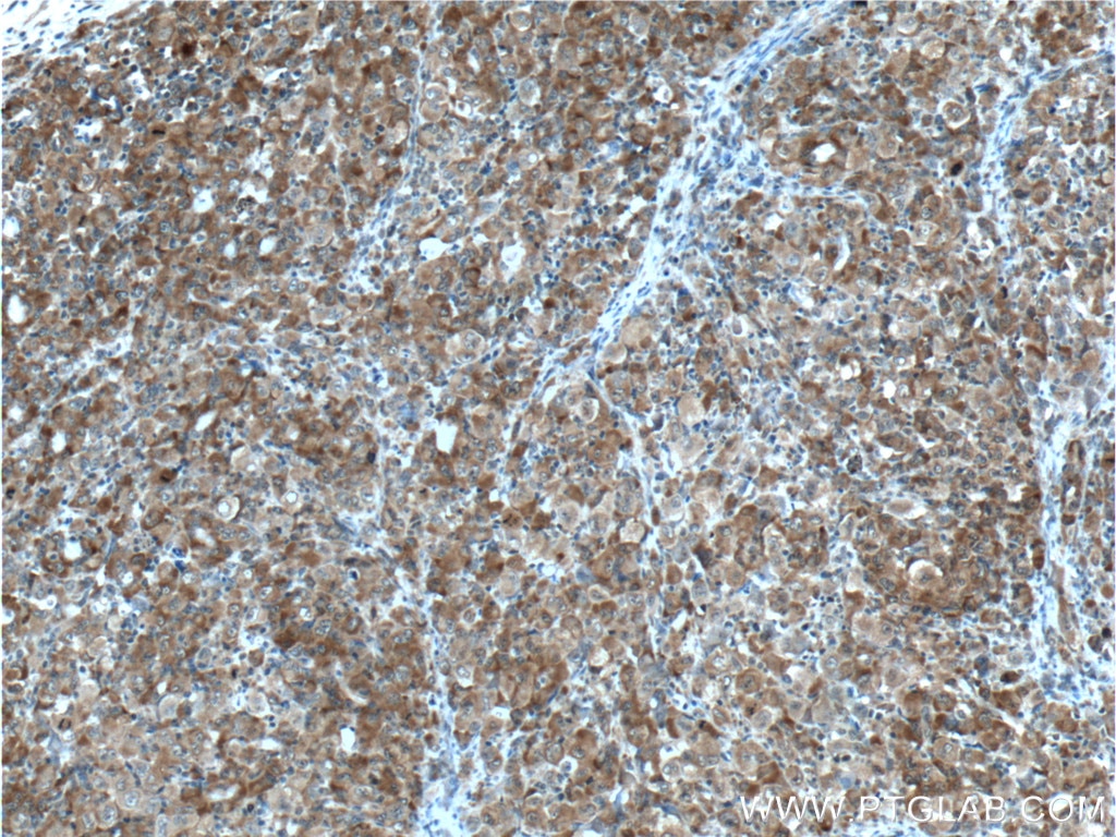 Immunohistochemistry (IHC) staining of human lymphoma tissue using G3BP1 Monoclonal antibody (66486-1-Ig)