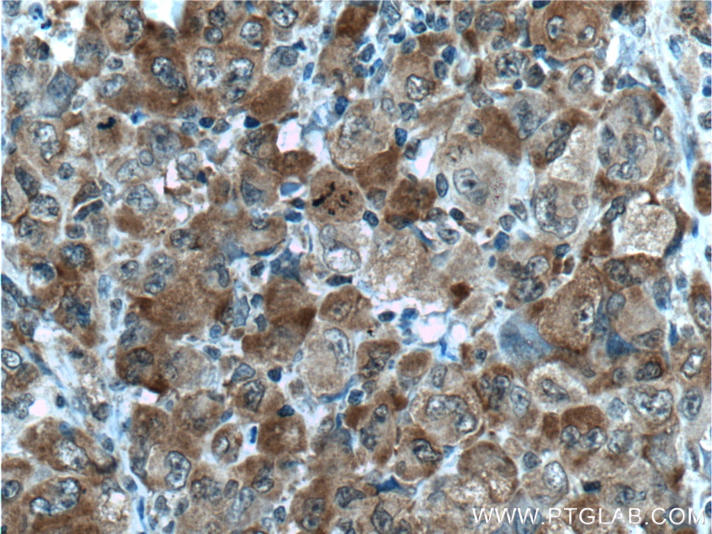 Immunohistochemistry (IHC) staining of human lymphoma tissue using G3BP1 Monoclonal antibody (66486-1-Ig)