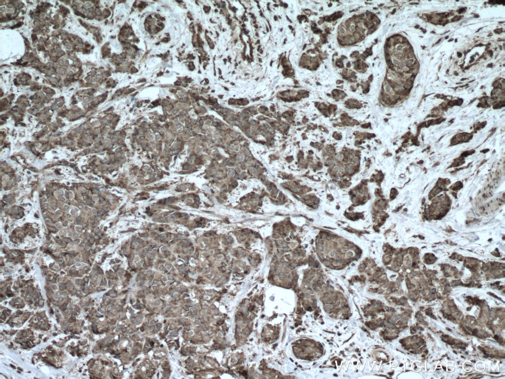 Immunohistochemistry (IHC) staining of human breast cancer tissue using G3BP1 Polyclonal antibody (13057-2-AP)