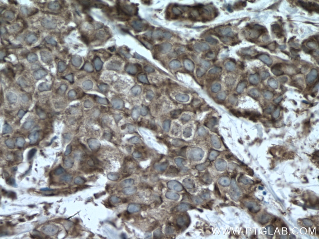 Immunohistochemistry (IHC) staining of human breast cancer tissue using G3BP1 Polyclonal antibody (13057-2-AP)