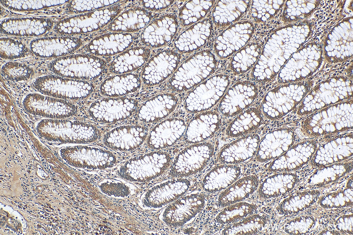 Immunohistochemistry (IHC) staining of human colon cancer tissue using G3BP1 Polyclonal antibody (13057-2-AP)