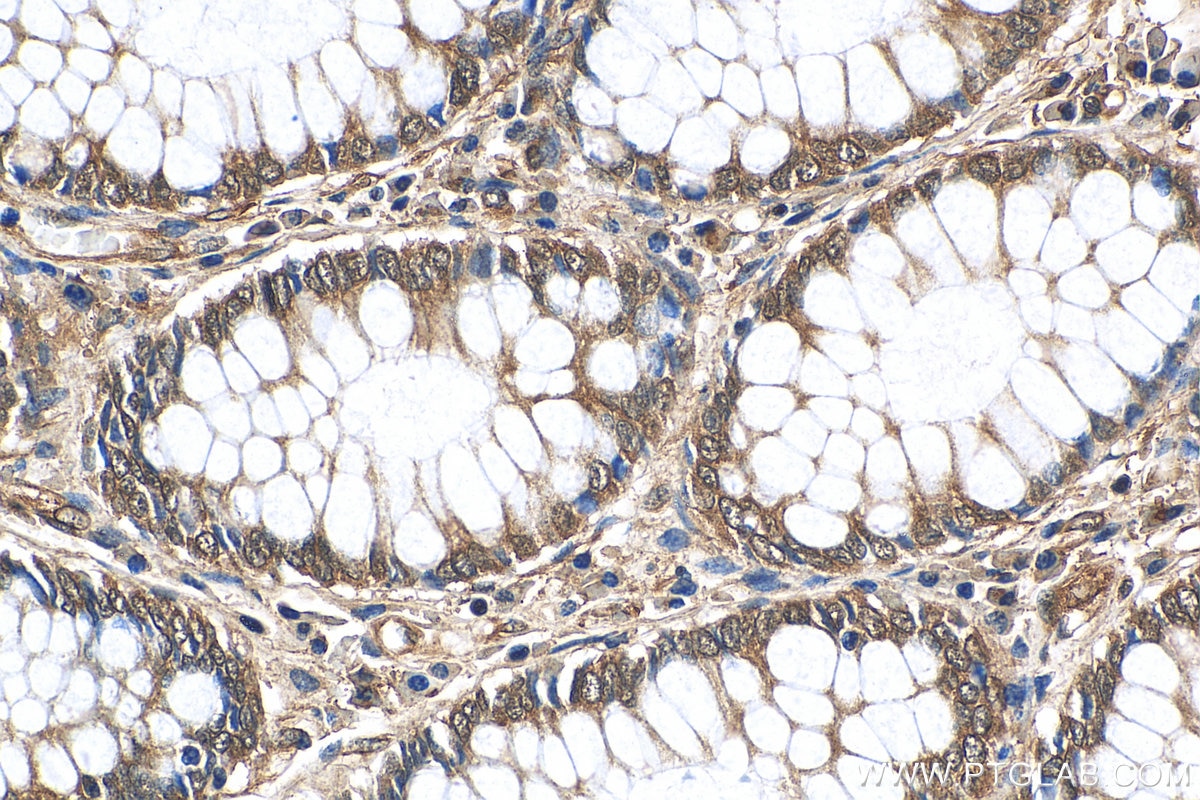 Immunohistochemistry (IHC) staining of human colon cancer tissue using G3BP1 Polyclonal antibody (13057-2-AP)