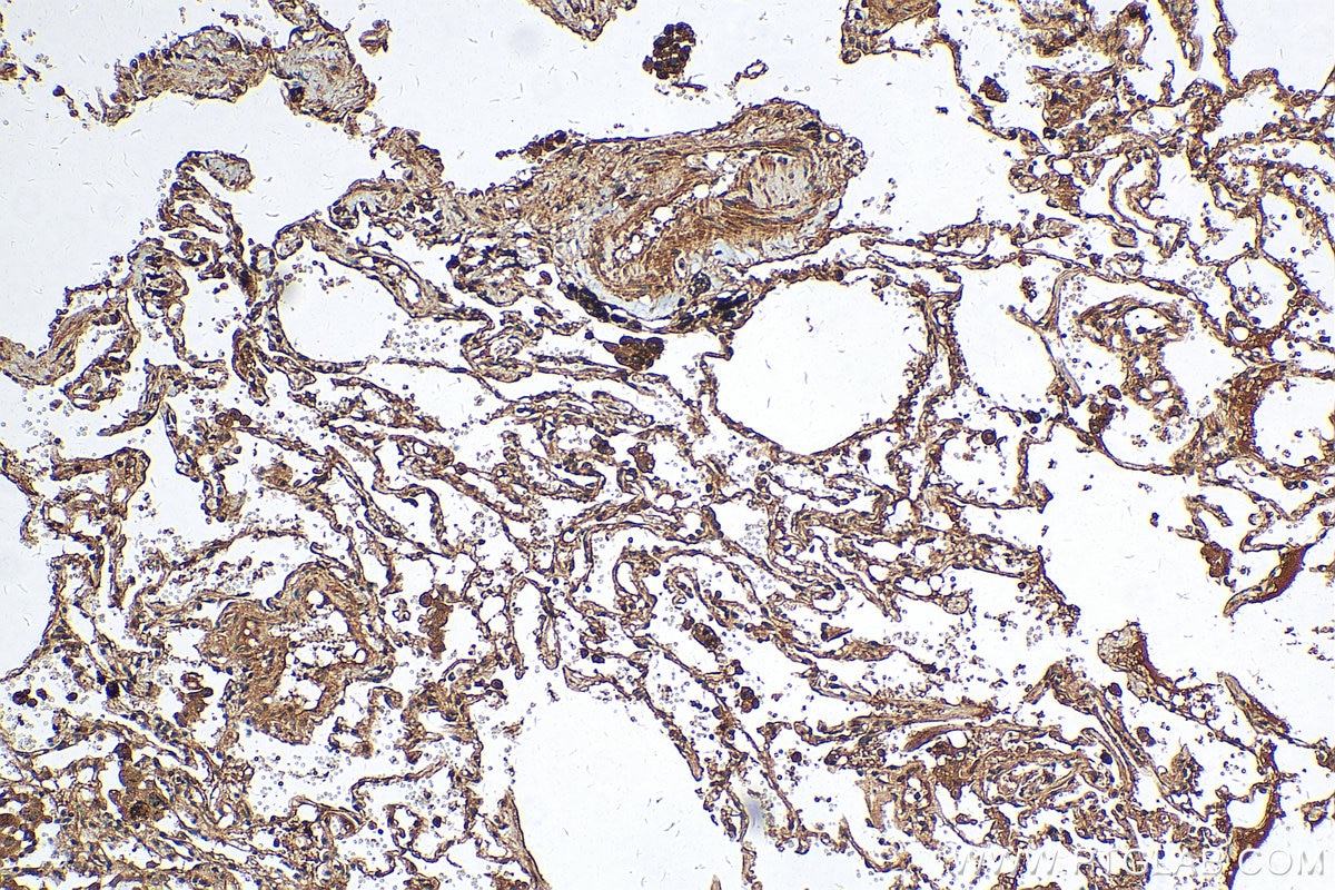 Immunohistochemistry (IHC) staining of human lung cancer tissue using G3BP1 Polyclonal antibody (13057-2-AP)