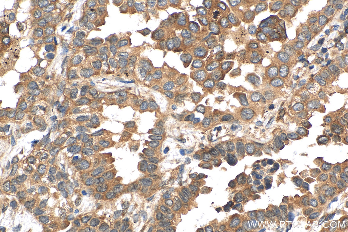 Immunohistochemistry (IHC) staining of human lung cancer tissue using G3BP1 Polyclonal antibody (13057-2-AP)