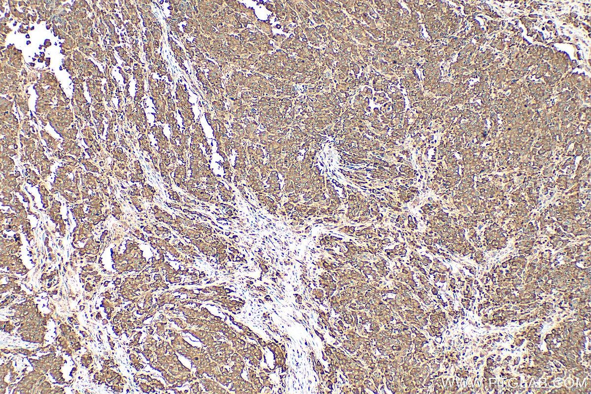 Immunohistochemistry (IHC) staining of human colon cancer tissue using G3BP1 Polyclonal antibody (13057-2-AP)