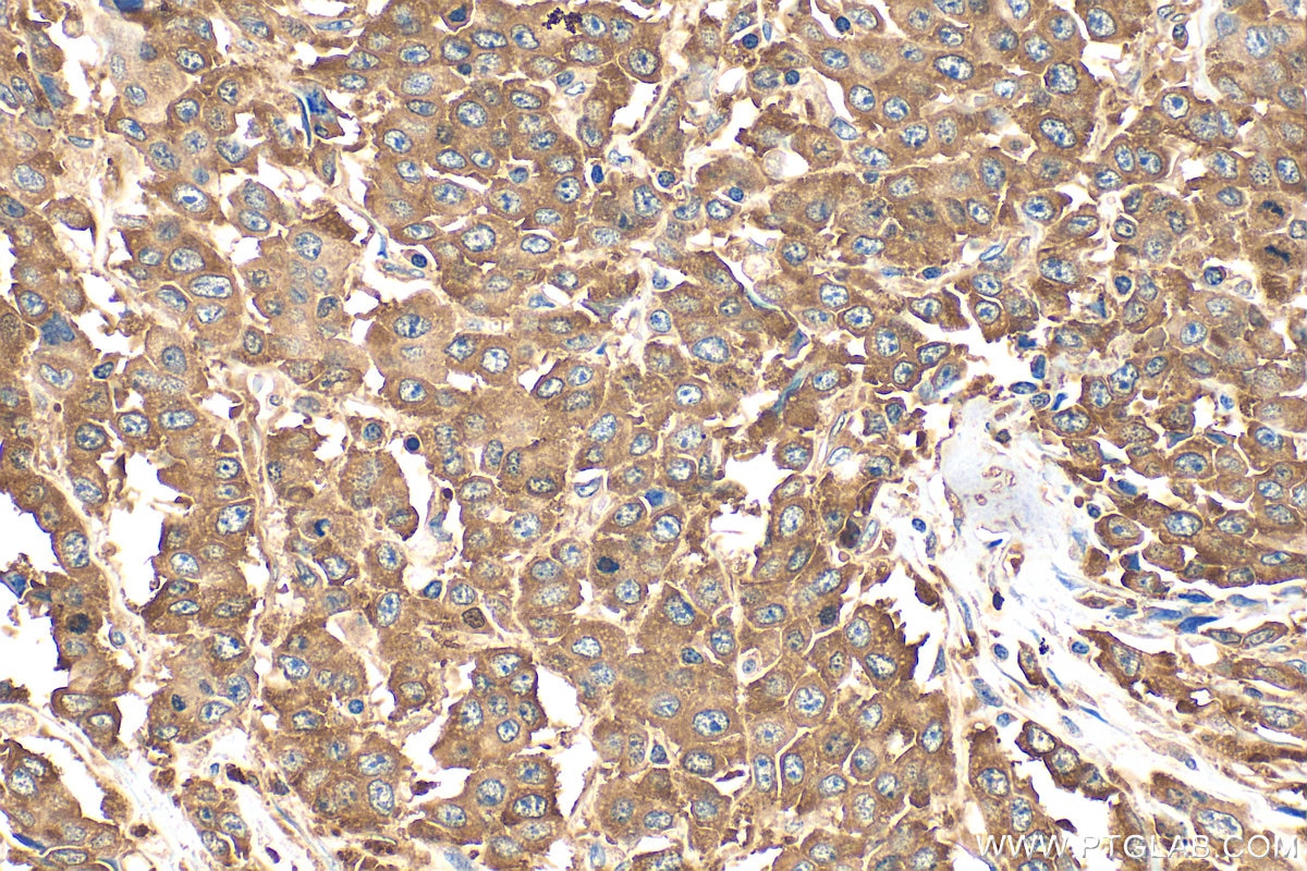 Immunohistochemistry (IHC) staining of human colon cancer tissue using G3BP1 Polyclonal antibody (13057-2-AP)