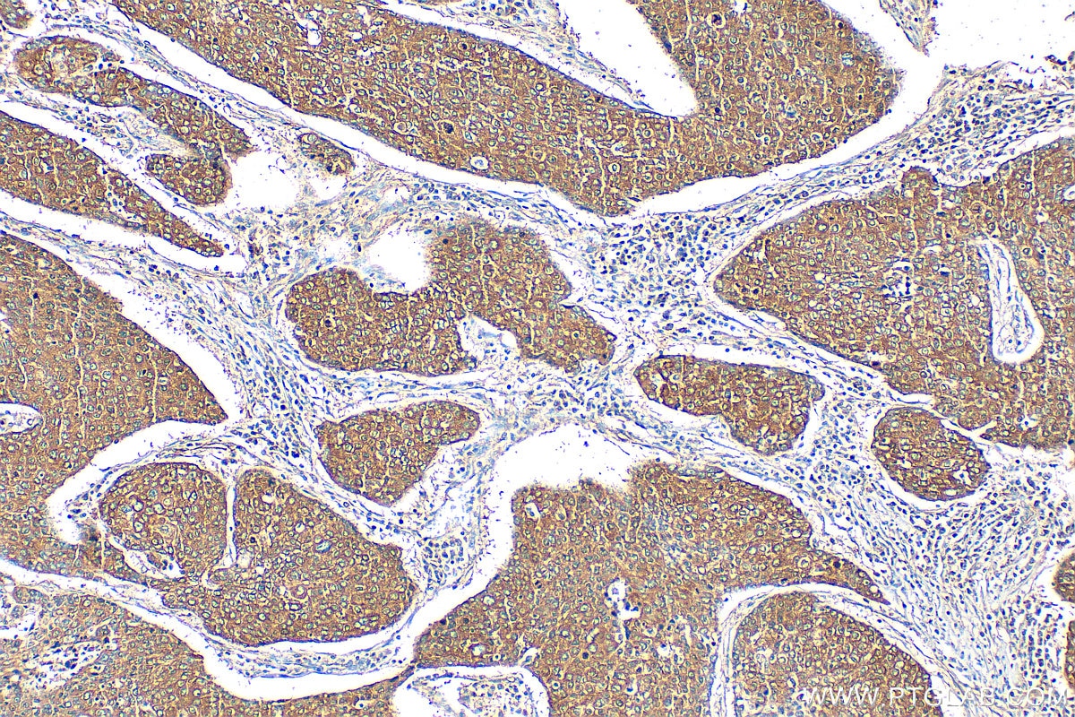 Immunohistochemistry (IHC) staining of human lung cancer tissue using G3BP1 Polyclonal antibody (13057-2-AP)