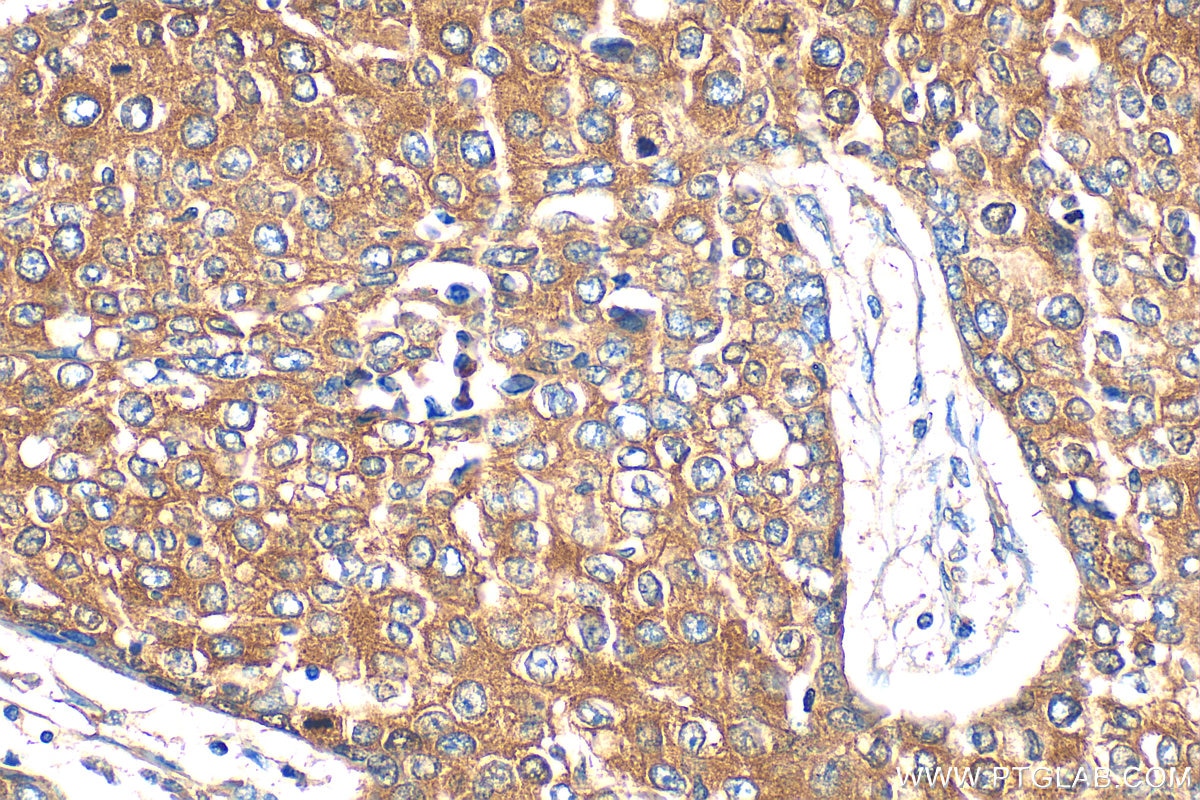 Immunohistochemistry (IHC) staining of human lung cancer tissue using G3BP1 Polyclonal antibody (13057-2-AP)