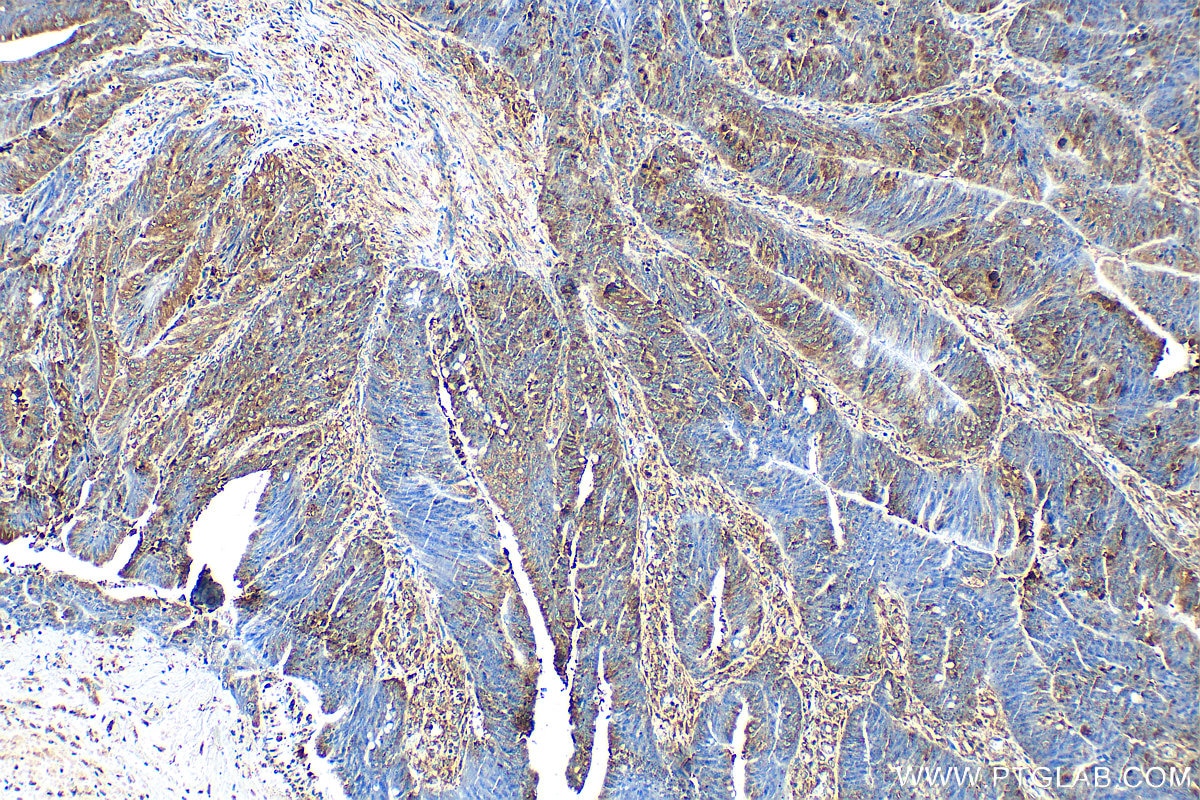 Immunohistochemistry (IHC) staining of human colon cancer tissue using G3BP1 Polyclonal antibody (13057-2-AP)
