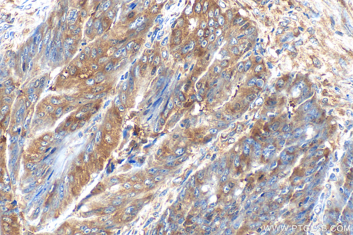 Immunohistochemistry (IHC) staining of human colon cancer tissue using G3BP1 Polyclonal antibody (13057-2-AP)
