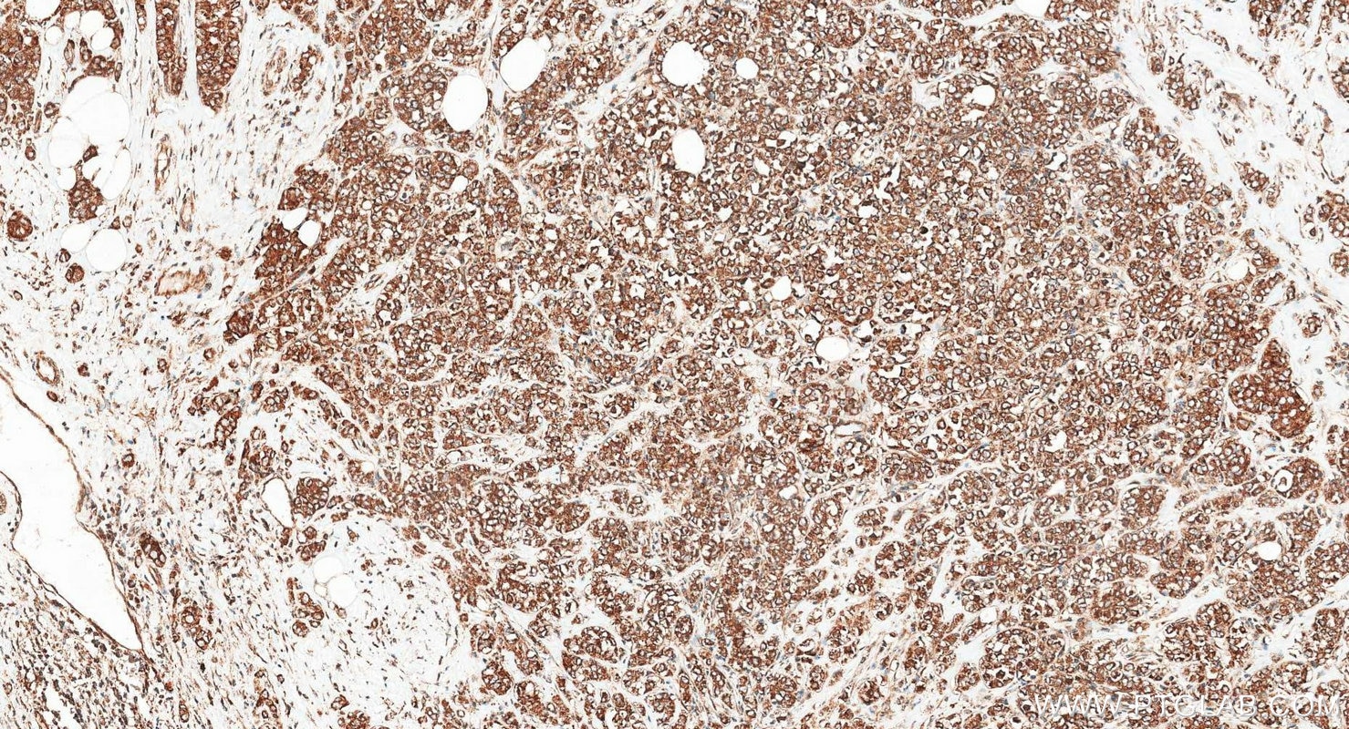 Immunohistochemistry (IHC) staining of human breast cancer tissue using G3BP1 Polyclonal antibody (13057-2-AP)