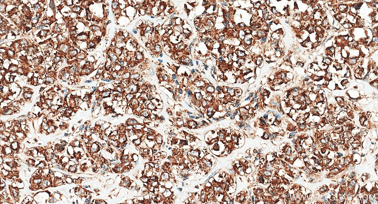 Immunohistochemistry (IHC) staining of human breast cancer tissue using G3BP1 Polyclonal antibody (13057-2-AP)