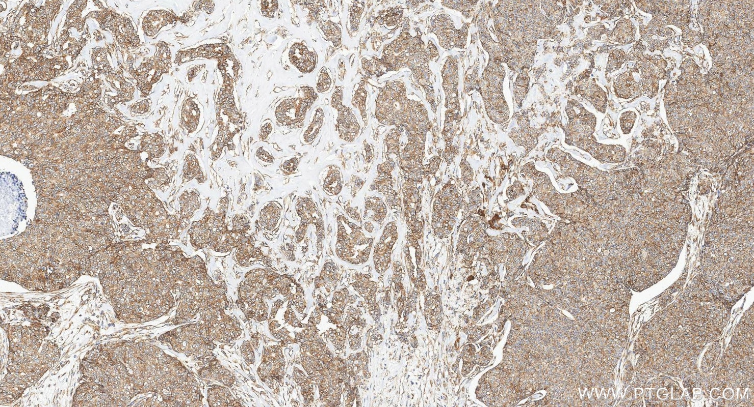 Immunohistochemistry (IHC) staining of human breast cancer tissue using G3BP1 Polyclonal antibody (13057-2-AP)
