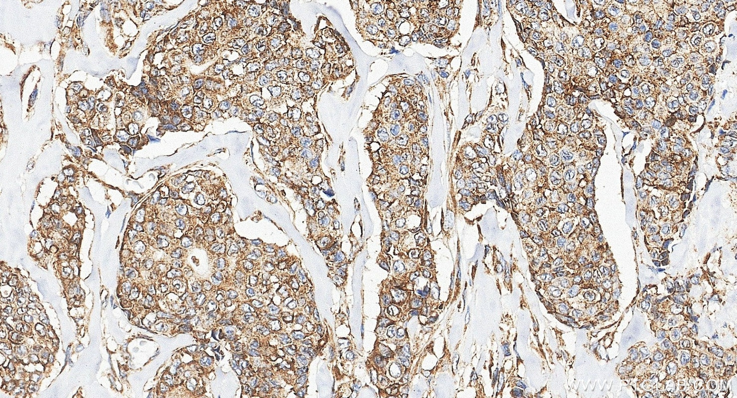 Immunohistochemistry (IHC) staining of human breast cancer tissue using G3BP1 Polyclonal antibody (13057-2-AP)