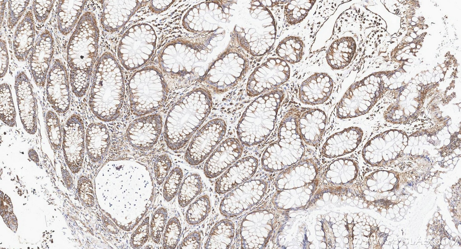 Immunohistochemistry (IHC) staining of human colorectal cancer tissue using G3BP1 Polyclonal antibody (13057-2-AP)