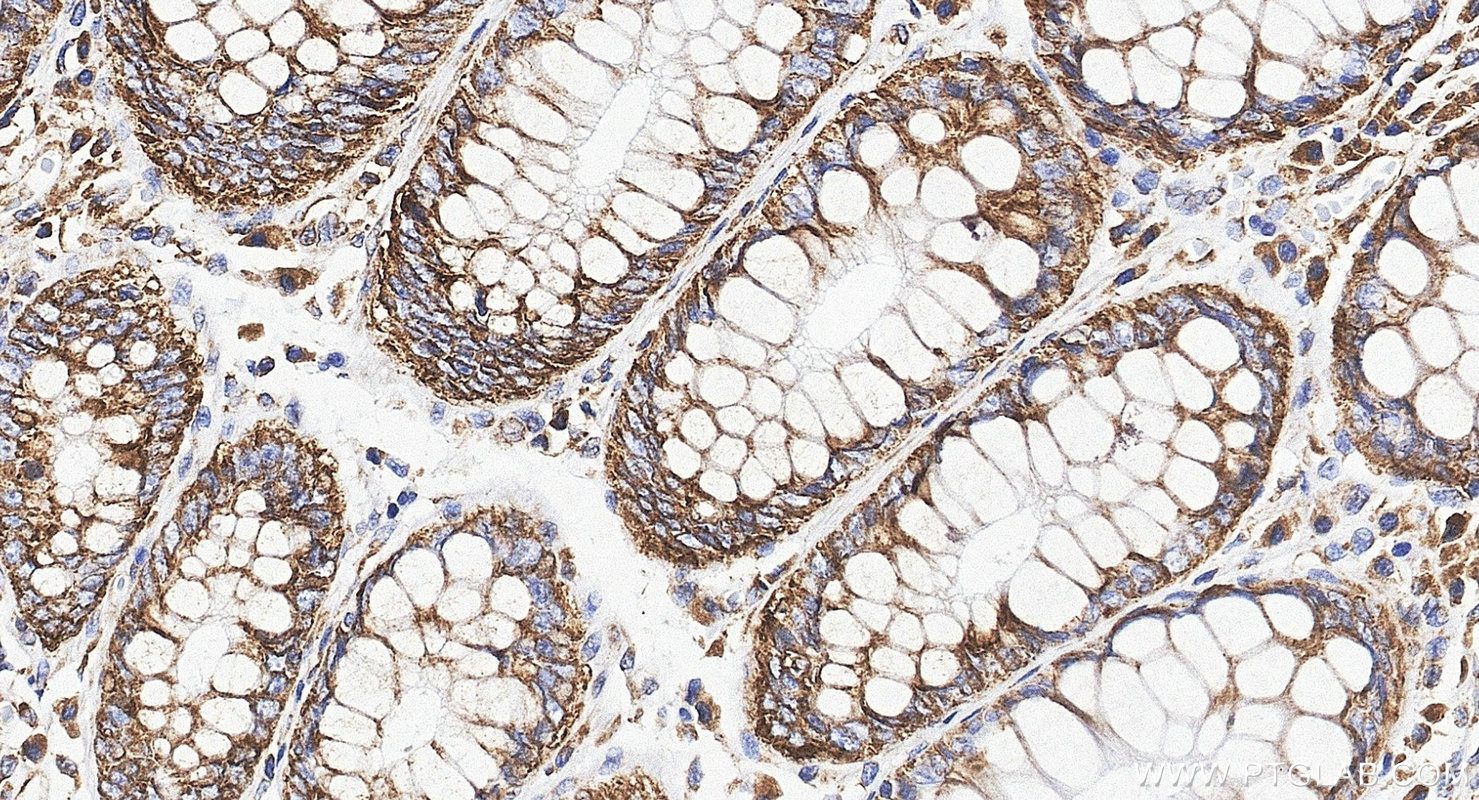 Immunohistochemistry (IHC) staining of human colorectal cancer tissue using G3BP1 Polyclonal antibody (13057-2-AP)