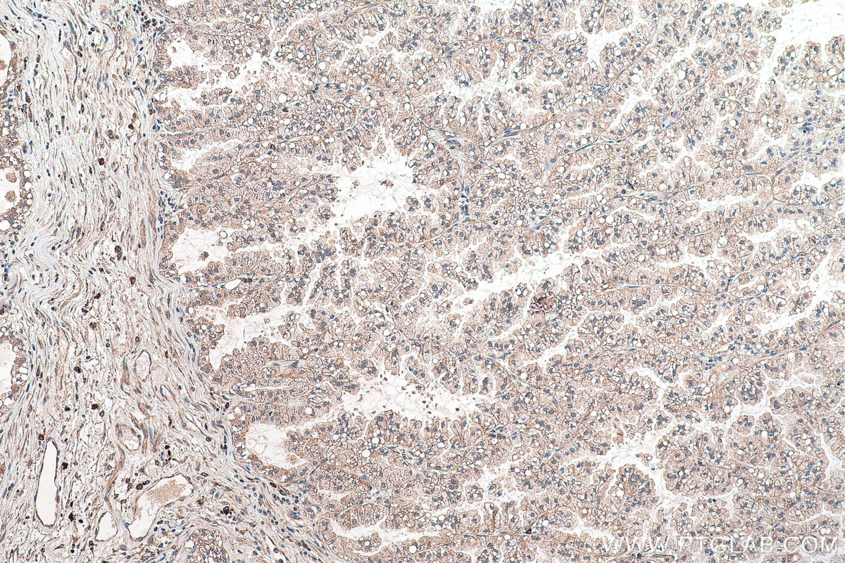 Immunohistochemistry (IHC) staining of human lung cancer tissue using G3BP2 Polyclonal antibody (16276-1-AP)
