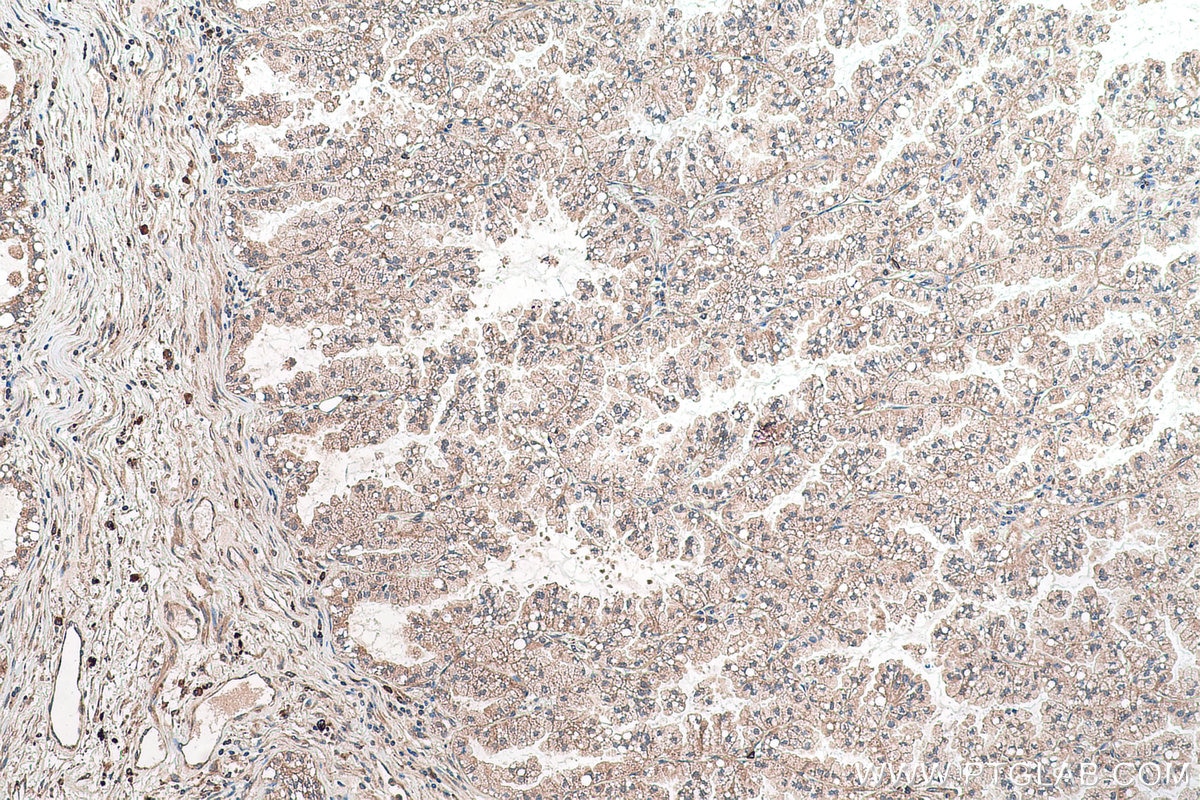 IHC staining of human lung cancer using 16276-1-AP