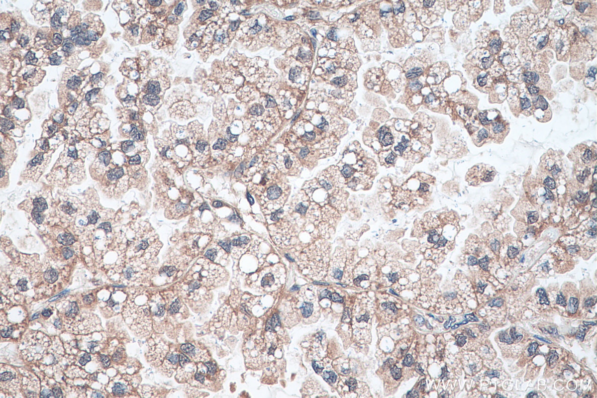 Immunohistochemistry (IHC) staining of human lung cancer tissue using G3BP2 Polyclonal antibody (16276-1-AP)