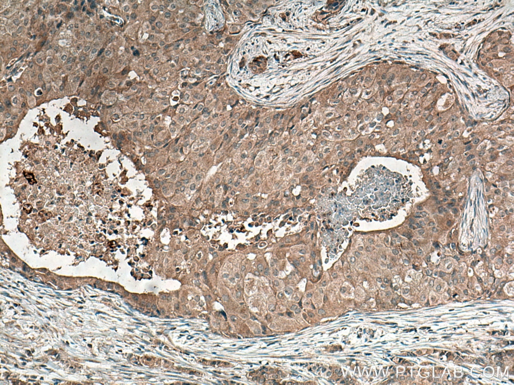 Immunohistochemistry (IHC) staining of human breast cancer tissue using G6PC Monoclonal antibody (66860-1-Ig)