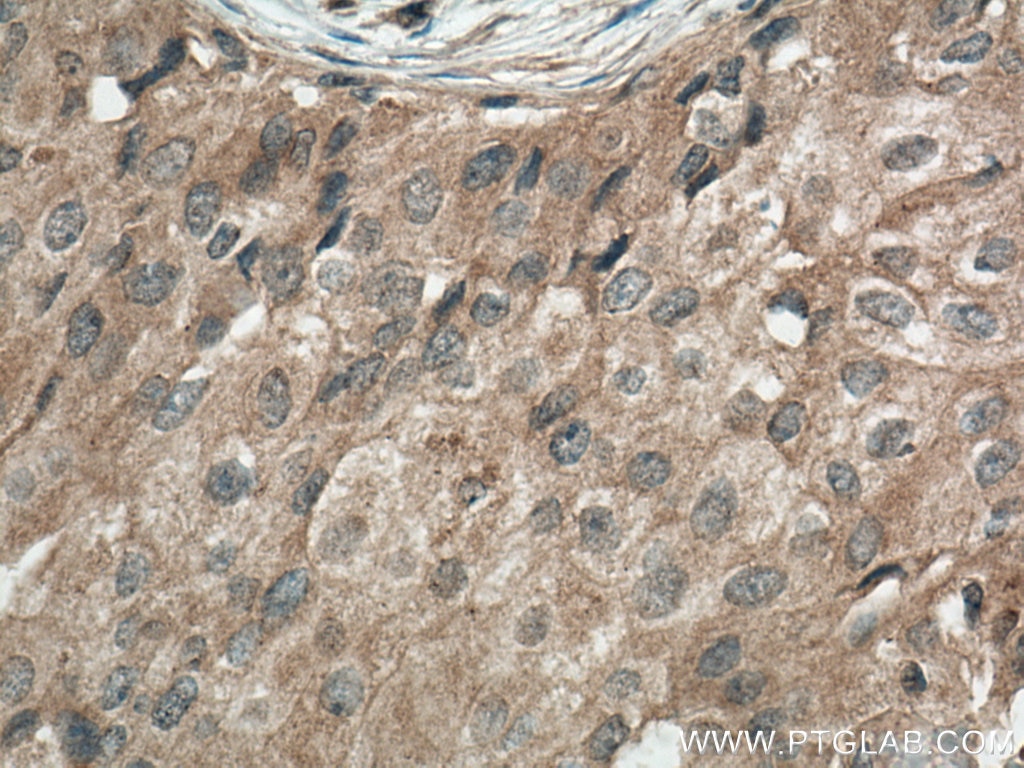 Immunohistochemistry (IHC) staining of human breast cancer tissue using G6PC Monoclonal antibody (66860-1-Ig)