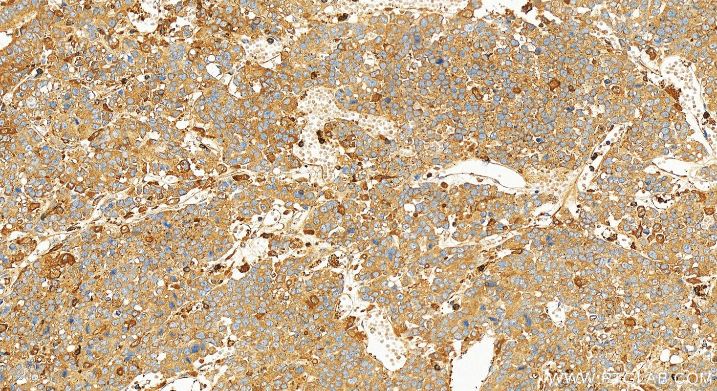 Immunohistochemical analysis of paraffin-embedded human hepatocellular carcinoma slide using 25413-1-AP (G6PD antibody) at dilution of 1:1000 (under 20x lens). Heat mediated antigen retrieval with Tris-EDTA buffer (pH 9.0). Immunohistochemistry (IHC) staining of human hepatocellular carcinoma using G6PD Polyclonal antibody (25413-1-AP)