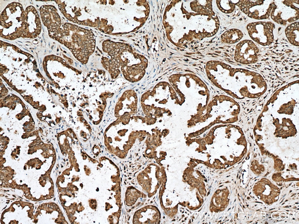 Immunohistochemistry (IHC) staining of human ovary tumor tissue using G6PD Polyclonal antibody (25413-1-AP)