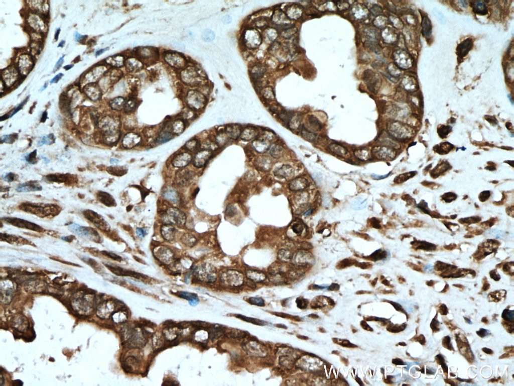 Immunohistochemistry (IHC) staining of human ovary tumor tissue using G6PD Polyclonal antibody (25413-1-AP)